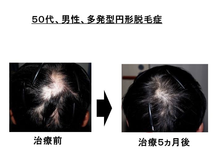円形脱毛症　病院